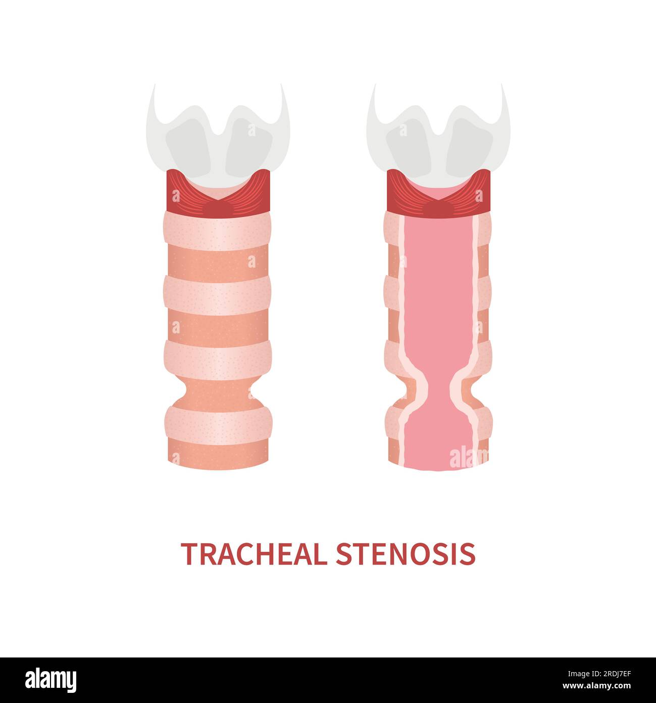 Tracheal stenosis, illustration Stock Photo