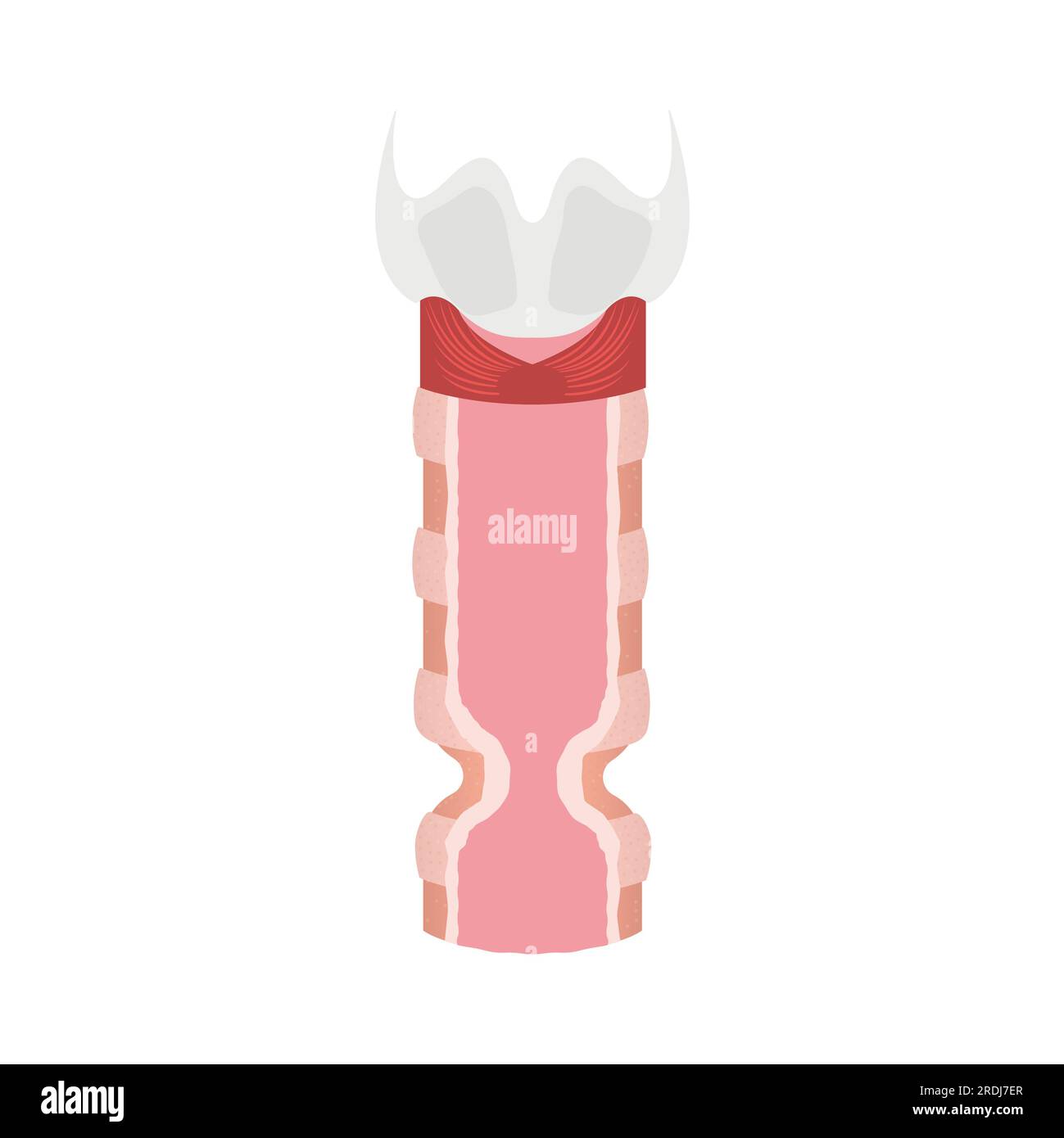 Tracheal stenosis, illustration Stock Photo