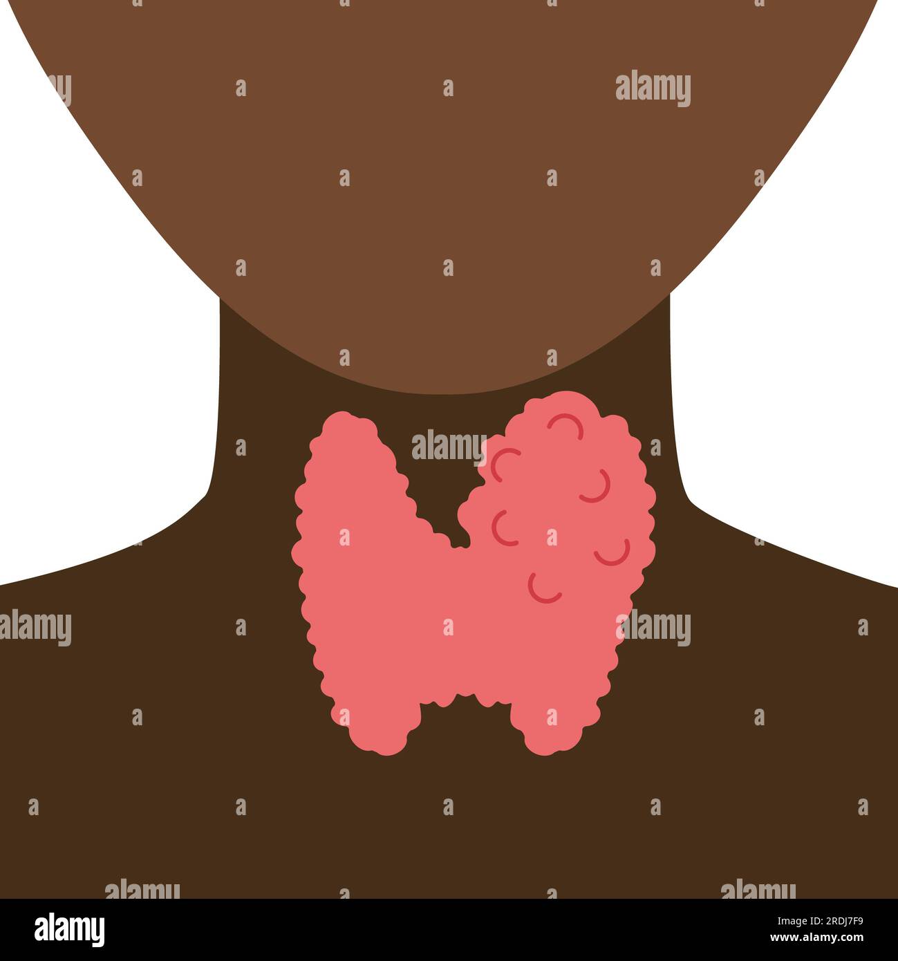 Enlarged thyroid gland, illustration Stock Photo