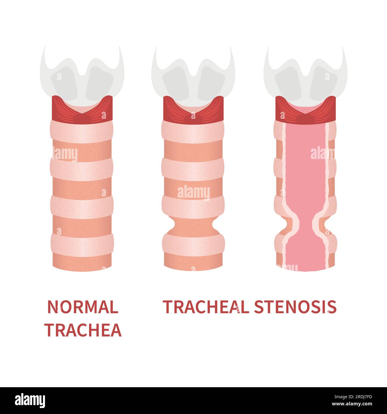 Tracheal stenosis, illustration Stock Photo