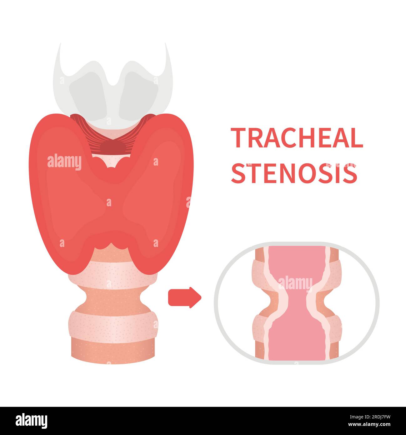 Tracheal stenosis, illustration Stock Photo