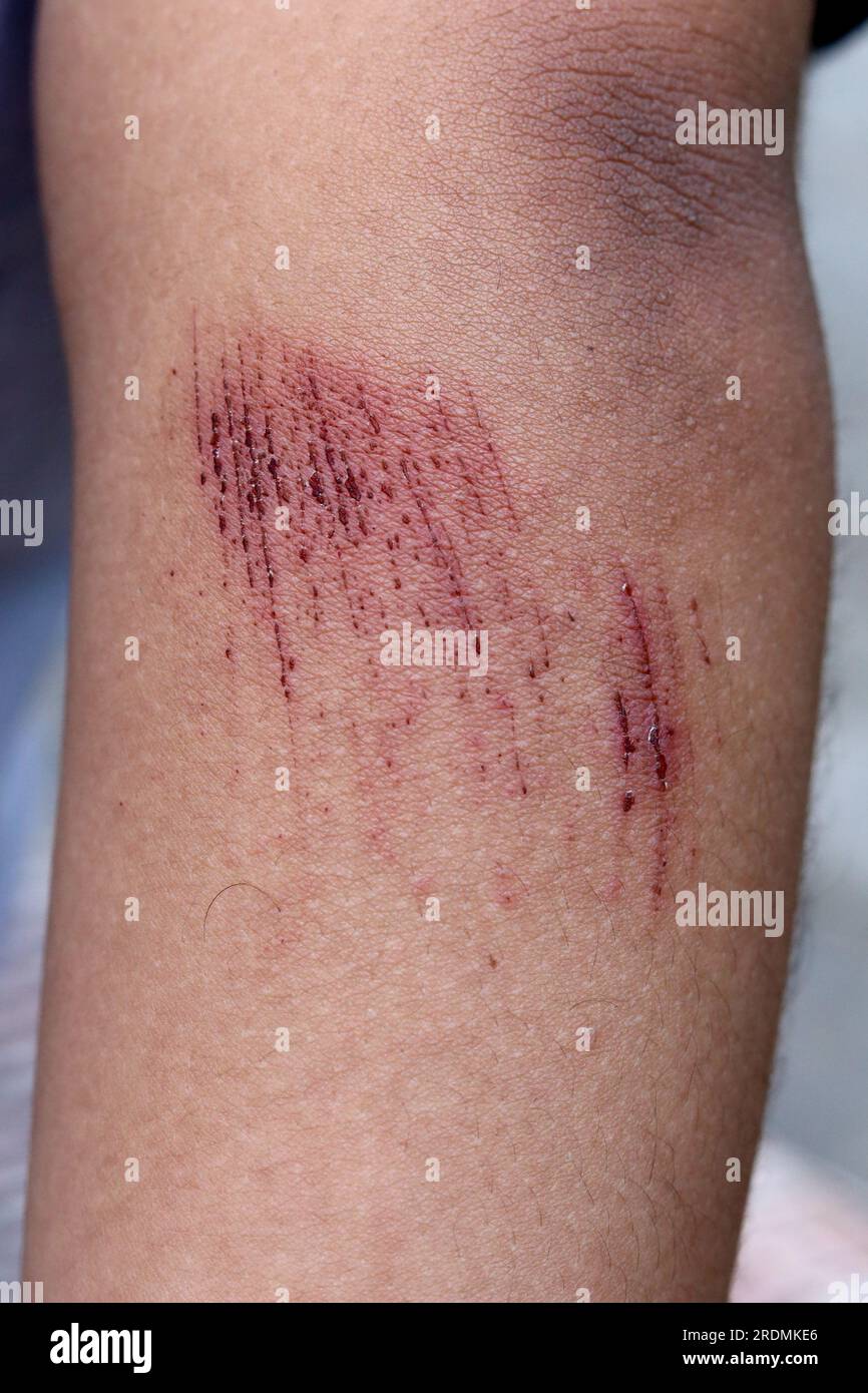 Wounds on the skin almost healed. Deep scratches on the skin Stock ...