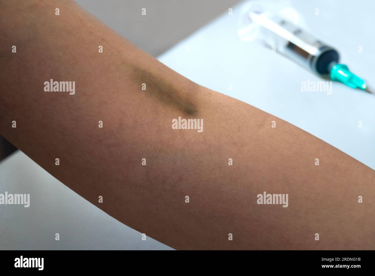Vein hematoma after blood sampling Stock Photo Alamy