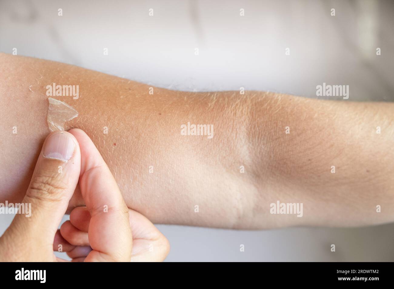 Exfoliation of the skin after sunburn. Man peeling off skin on his arm