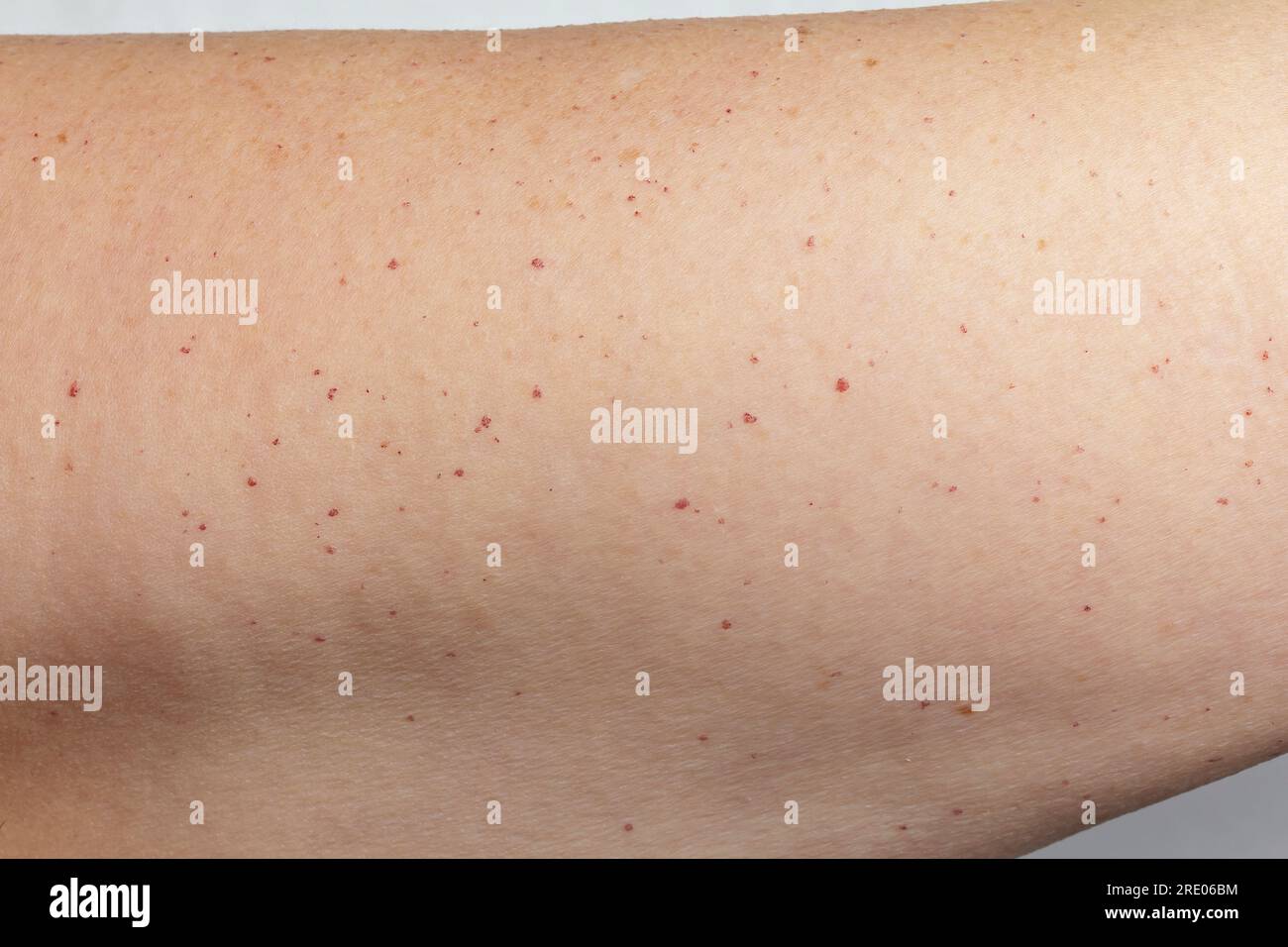Lots of small hemangioma and a few age spots on the upper arm skin of an 55 years old caucasian woman. Abnormal amount of spots and age of patient. Stock Photo