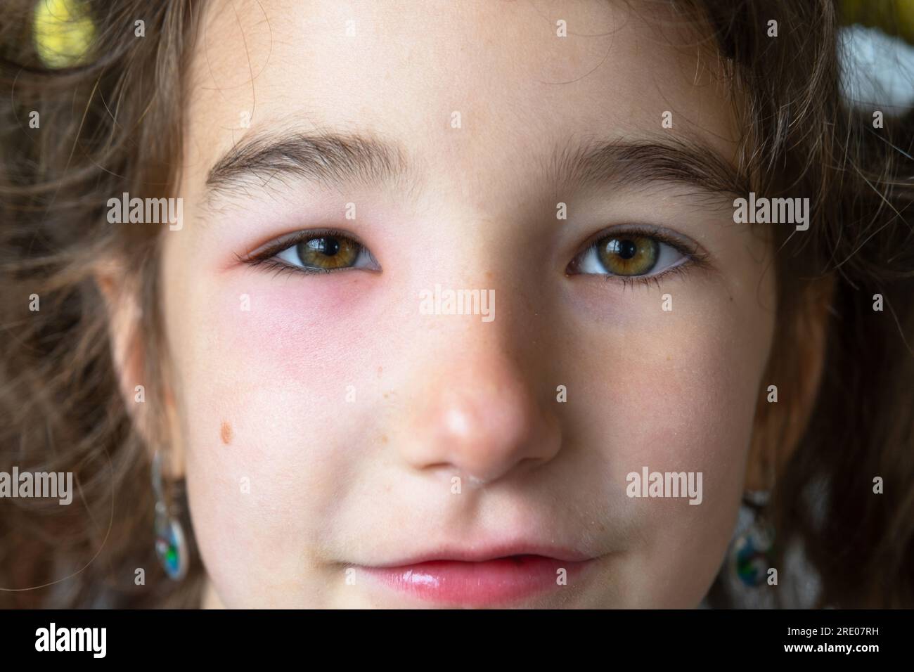 A red swollen eyelid on a child face in closeup is an allergy to an