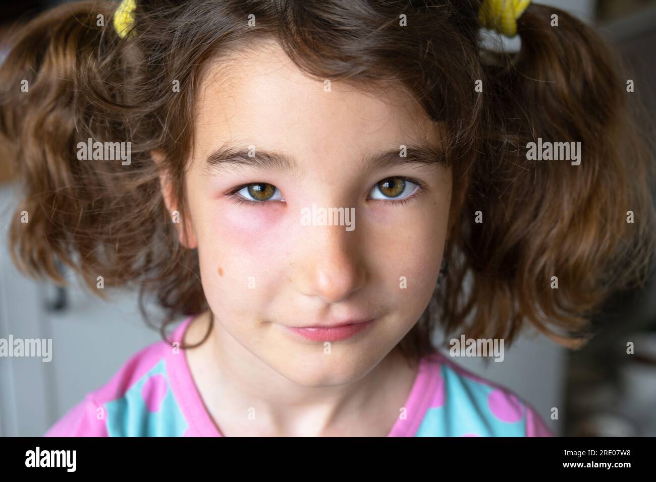 A red swollen eyelid on a child face in closeup is an allergy to an