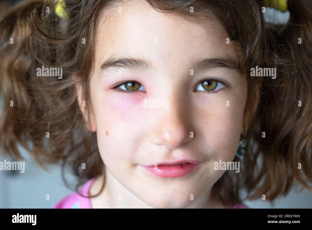 A red swollen eyelid on a child face in closeup is an allergy to an