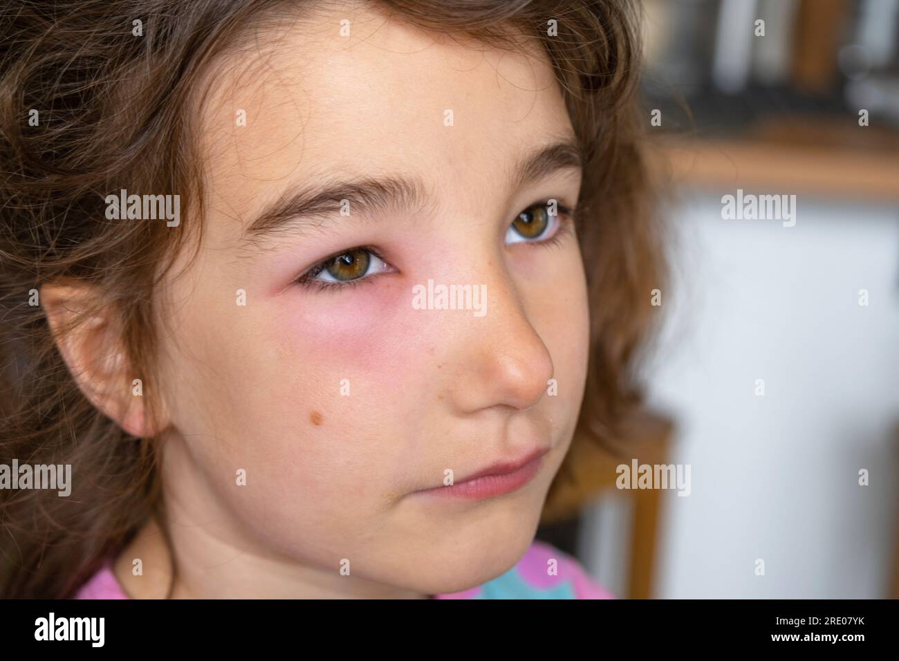 A red swollen eyelid on a child face in closeup is an allergy to an