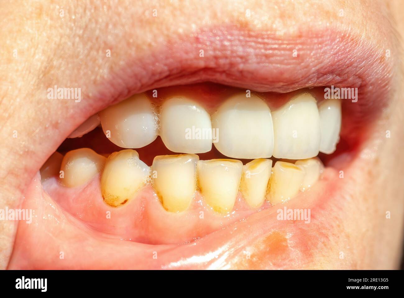 Yellow Teeth From Smoking