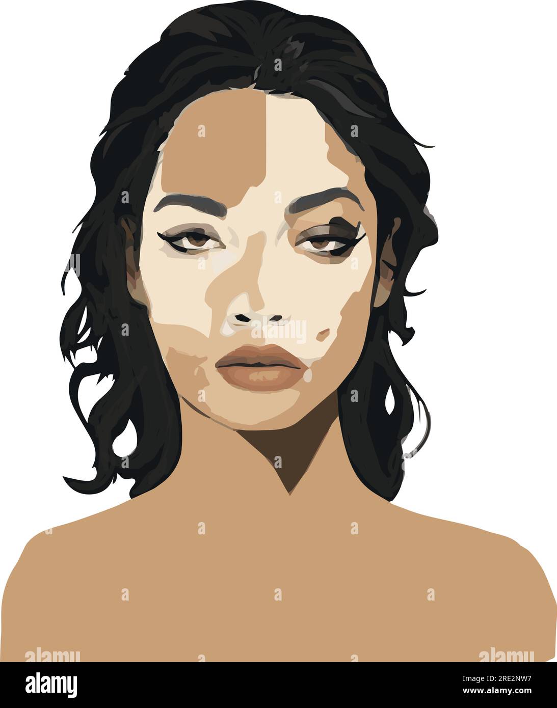 Illustration of black woman with facial skin hypopigmentation (vitiligo
