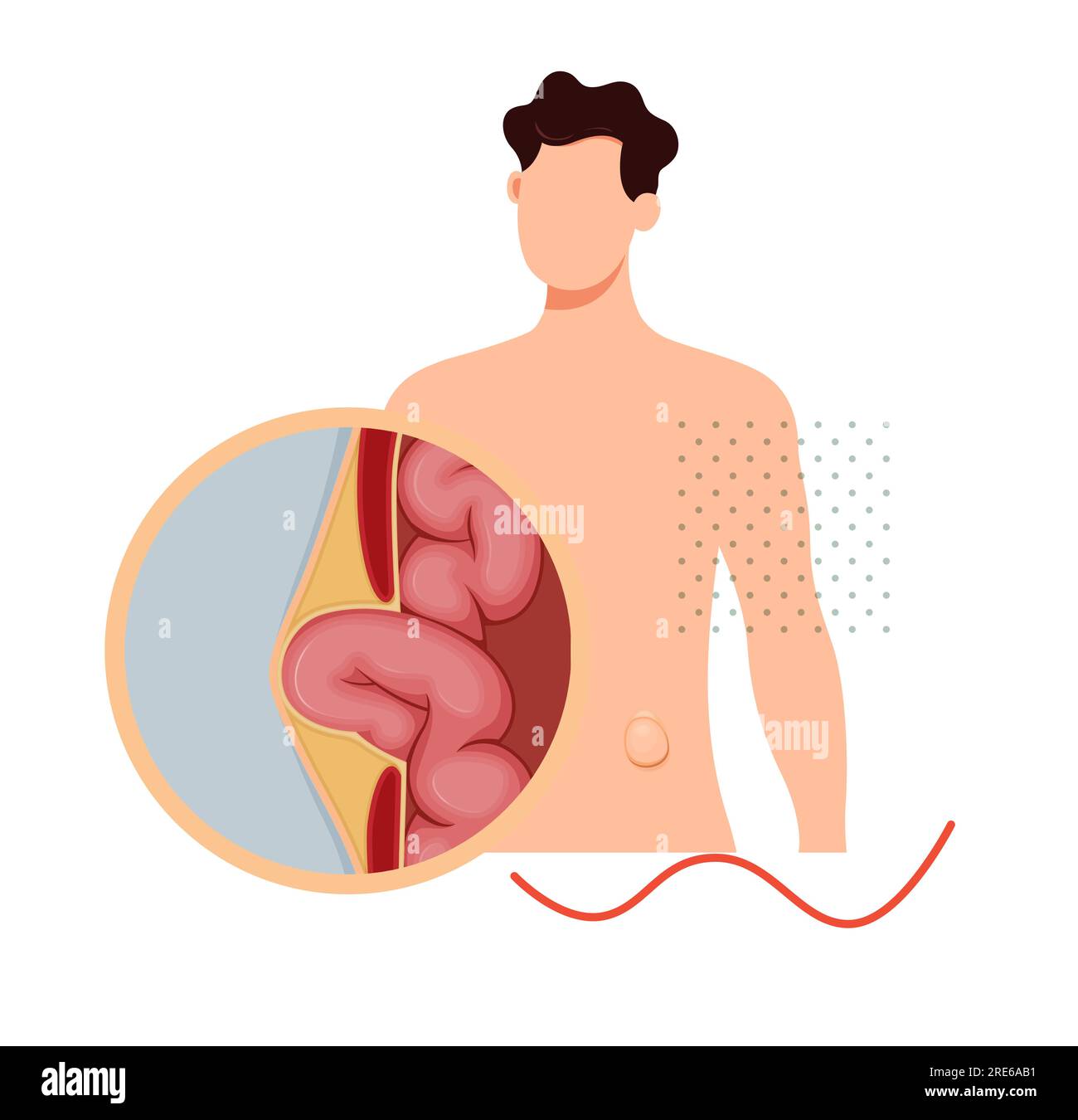 Strangulated Hernia - Section of the Small Intestines - Stock ...