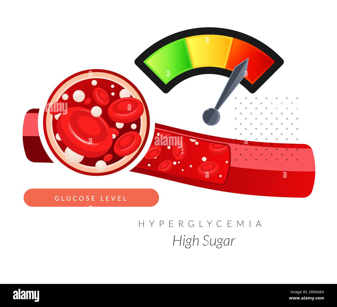 Hyperglycemia vector vectors hires stock photography and images Alamy