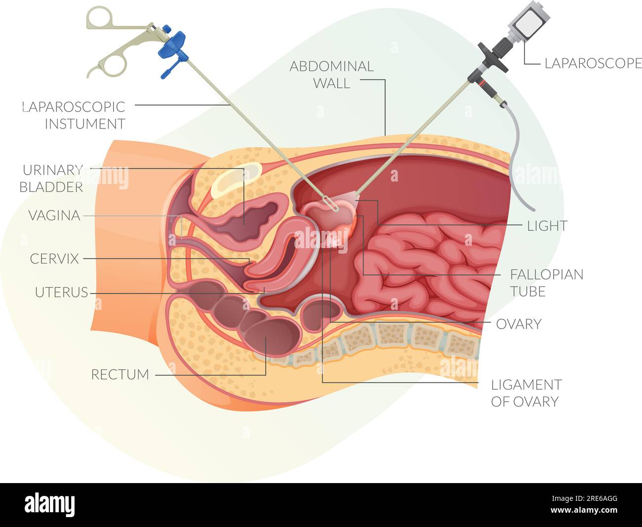 Gynaecological Laparoscopy Key Hole Surgery - Stock Illustration as EPS 10 File Stock Vector