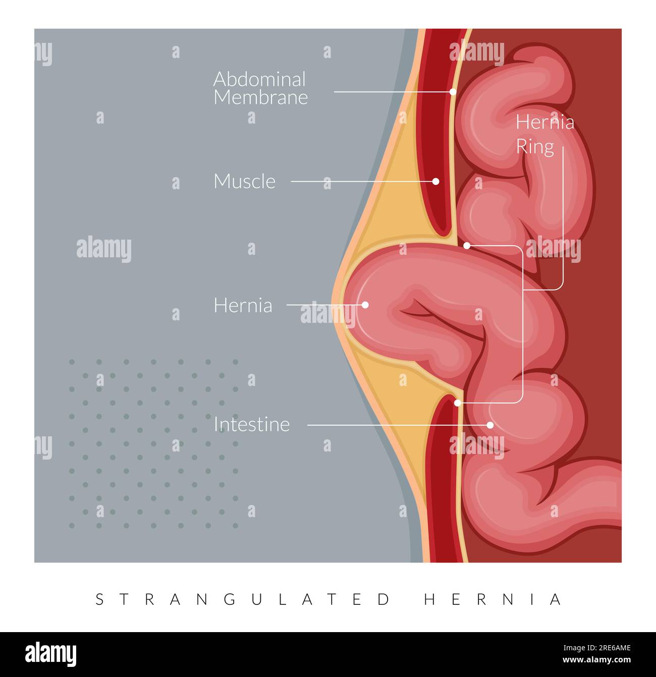 Strangulated Hernia -  Section of the Small Intestines - Stock Illustration as EPS 10 File Stock Vector