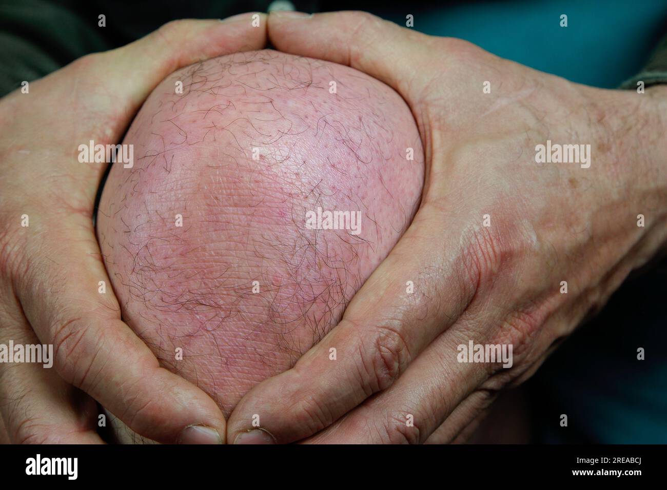 A man holds his red, inflamed and painful knee with his hands. Stock Photo