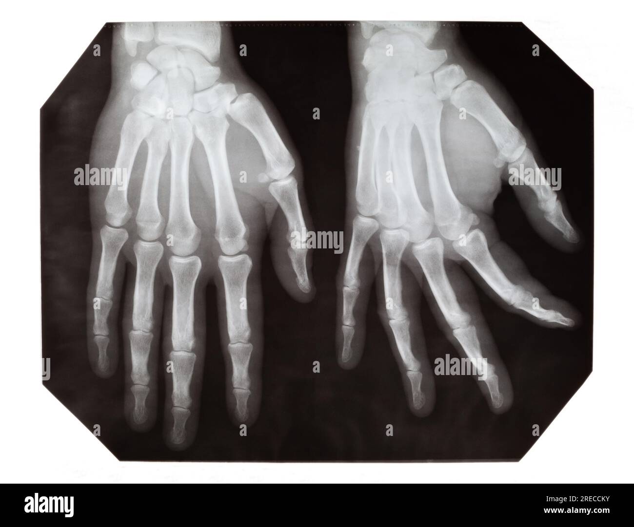 X-ray images of a hand with a fracture in different projections, on a white background Stock Photo