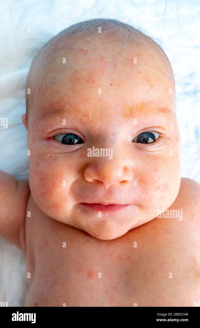 baby allergy skin. child dermatitis symptom problem rash. suffering