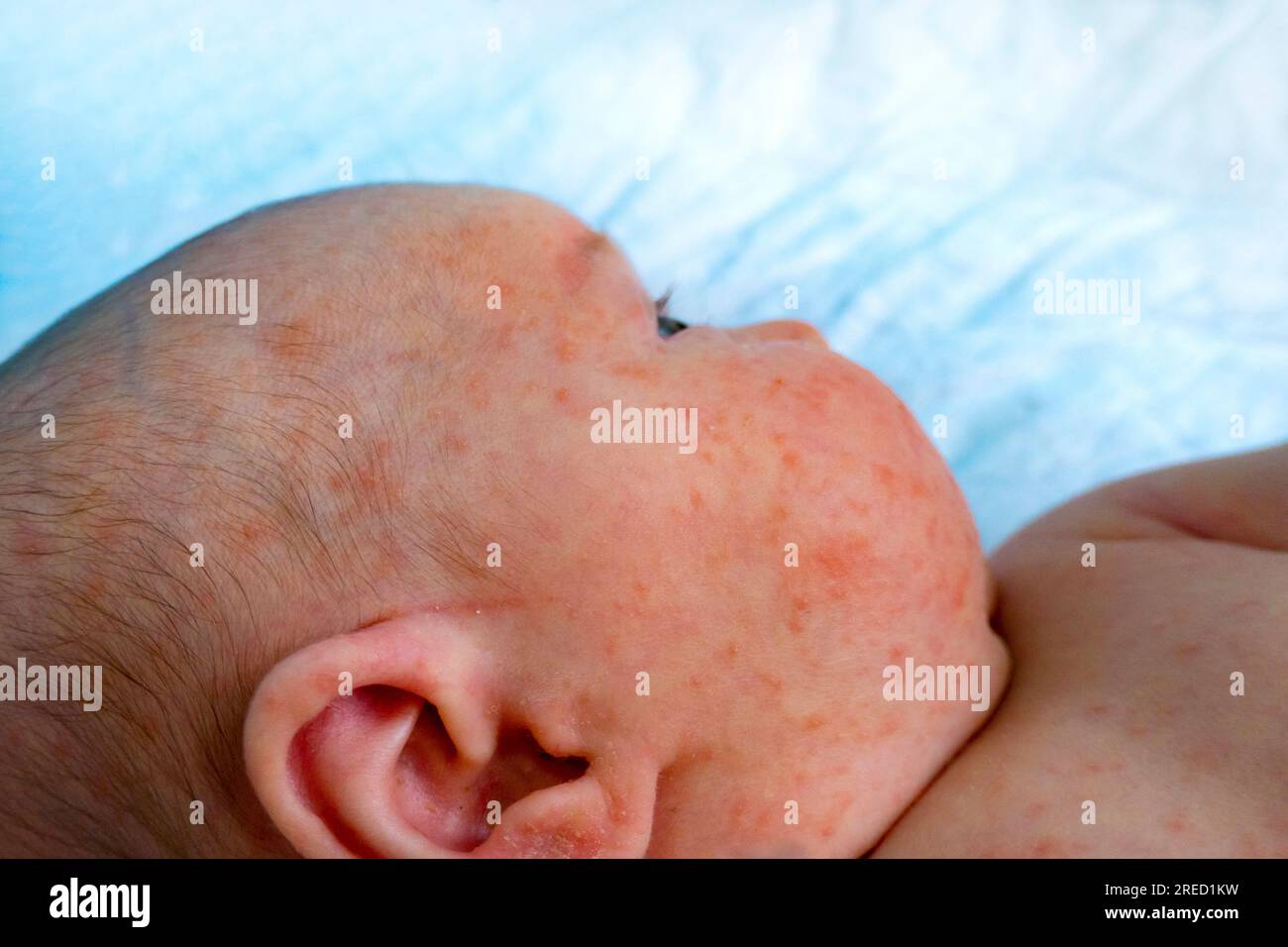 baby allergy skin. child dermatitis symptom problem rash. suffering