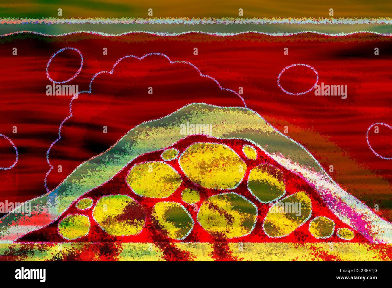 Arteriosclerosis is a common vascular disease in which the arteries become narrowed and hardened by deposits such as fats Stock Photo