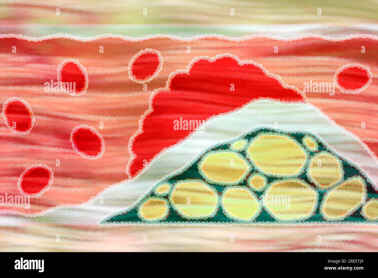 Arteriosclerosis is a common vascular disease in which the arteries become narrowed and hardened by deposits such as fats Stock Photo
