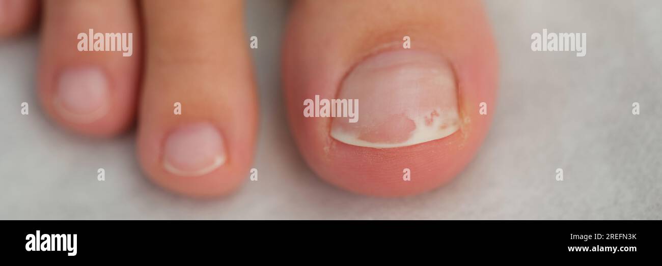 Damaged toenail close up, shallow depth of field. Stock Photo