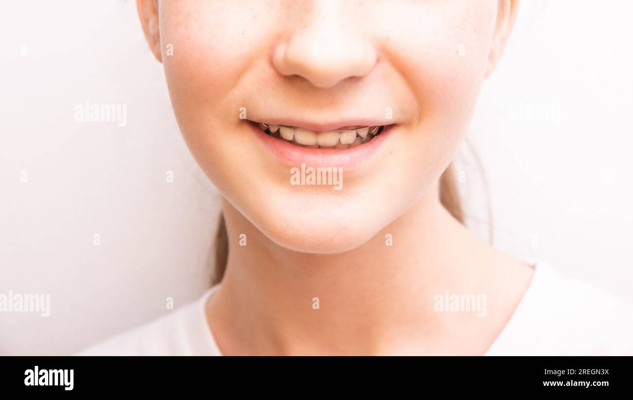 closeup lower part of teen girl face, open smile with brackets over white background Stock Photo