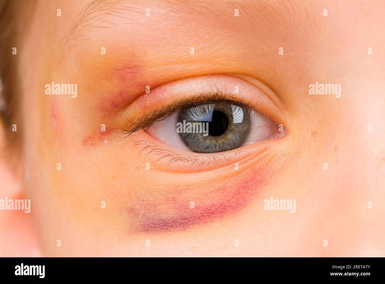 Portrait Black Blue Bruise Hi Res Stock Photography And Images Alamy