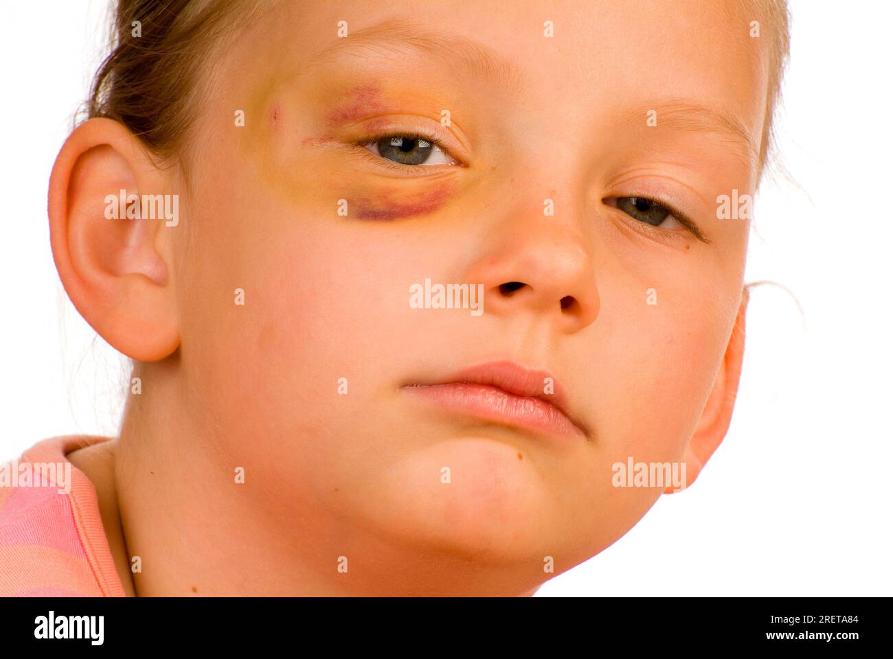 Girl with injury, black eye, hematoma, bruise, child abuse Stock Photo