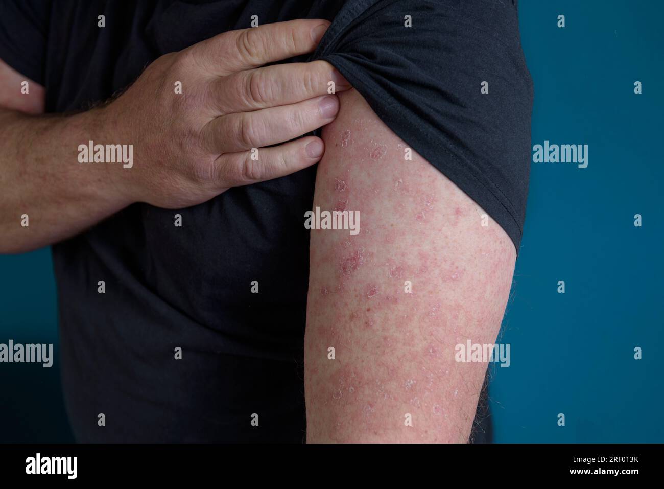 A red rash appears on the forearm. Erysipelas on the arm and upper part of the palm Stock Photo