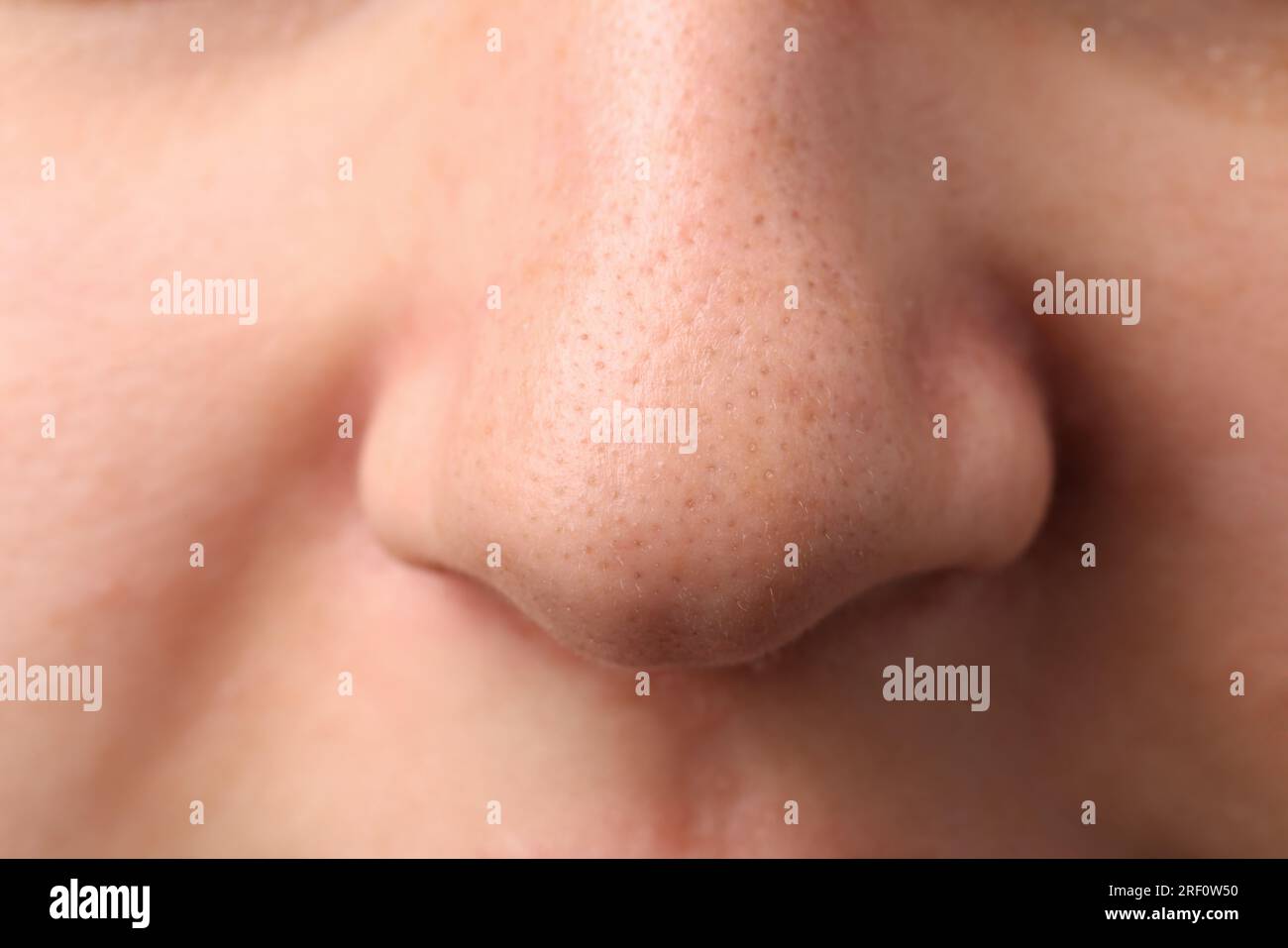 Young woman with acne problem, closeup view of nose Stock Photo