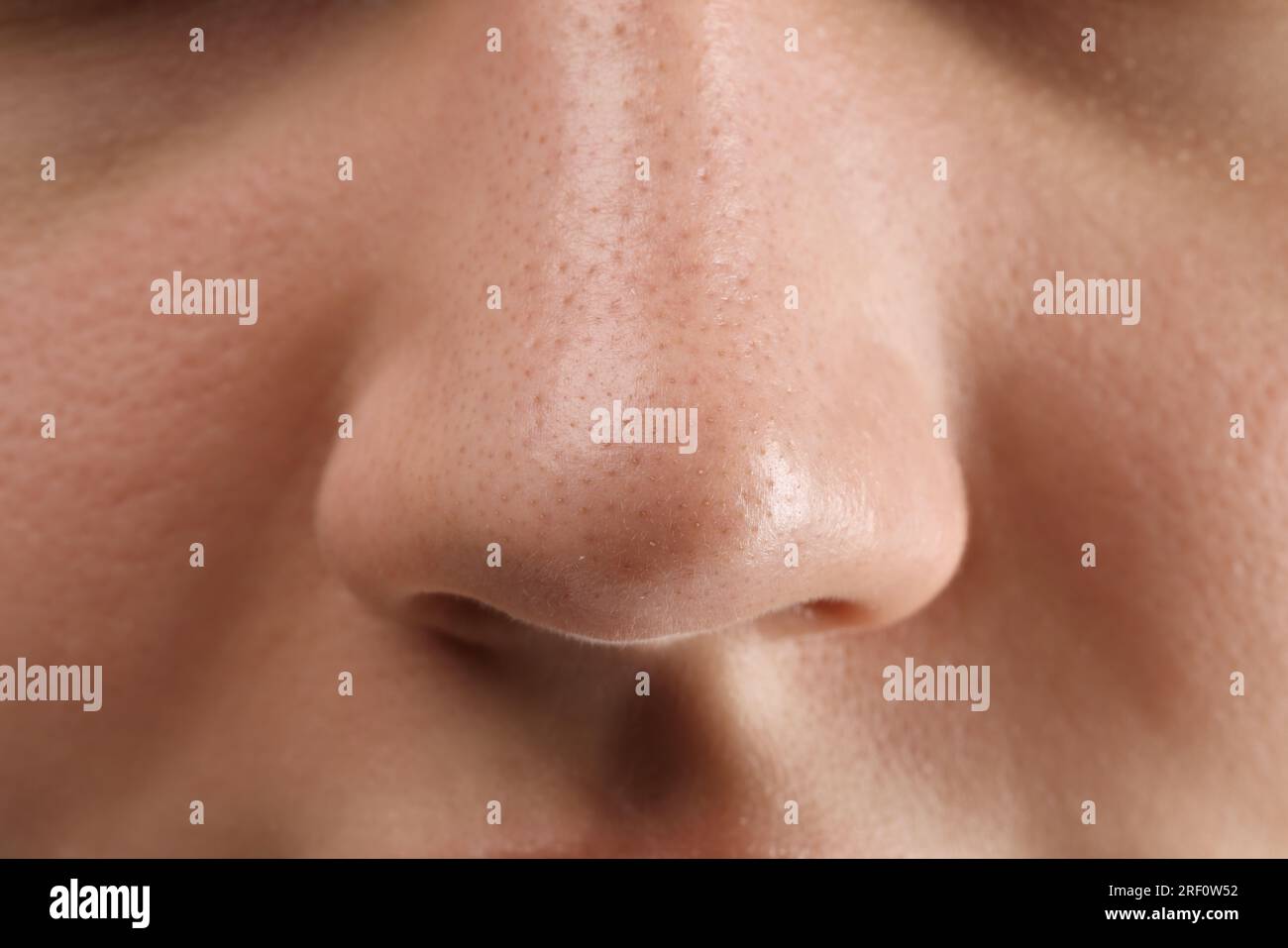 Young woman with acne problem, closeup view Stock Photo