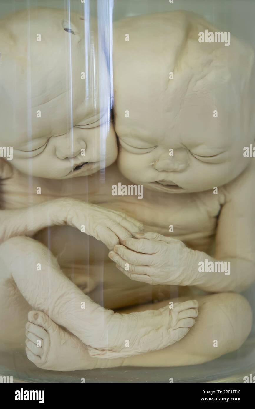 April 1, 2023 Gomel fully plastinated Siamese twins at an anatomical