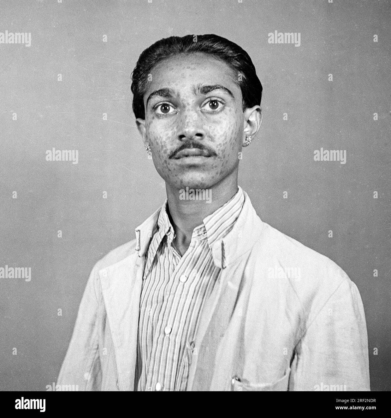 old vintage 1900s black and white studio portrait of Indian man small pox marks India 1940s Stock Photo