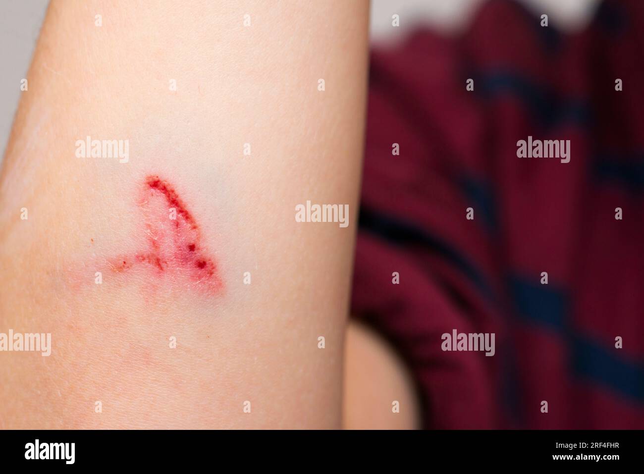 Deep scratches on the skin with bruises on the childs hand Stock Photo