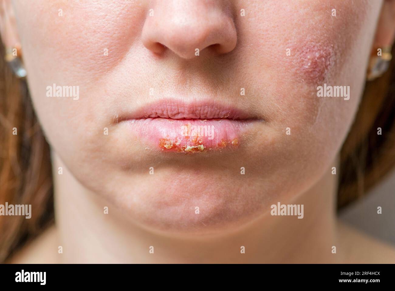 Close up of female lips affected by herpes virus. Stock Photo