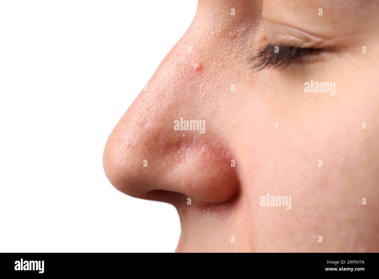 Young woman with acne problem on grey background, closeup Stock Photo