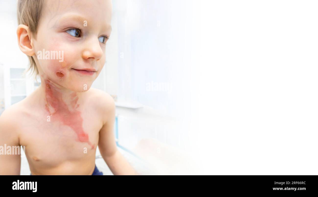 medical procedure dressing a boy with a firstdegree burn from boiling