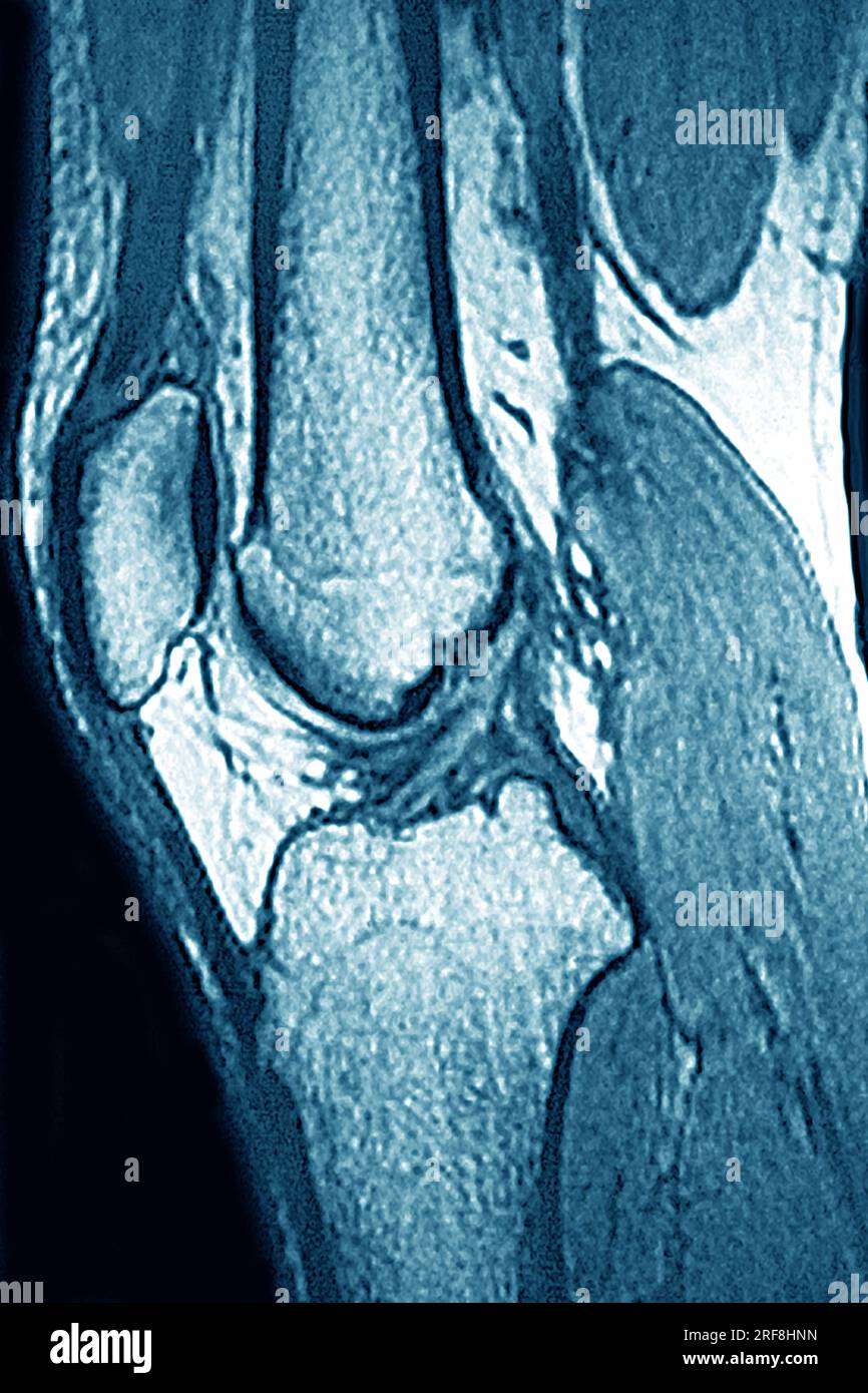 Normal knee visualized by MRI in sagittal section Stock Photo - Alamy