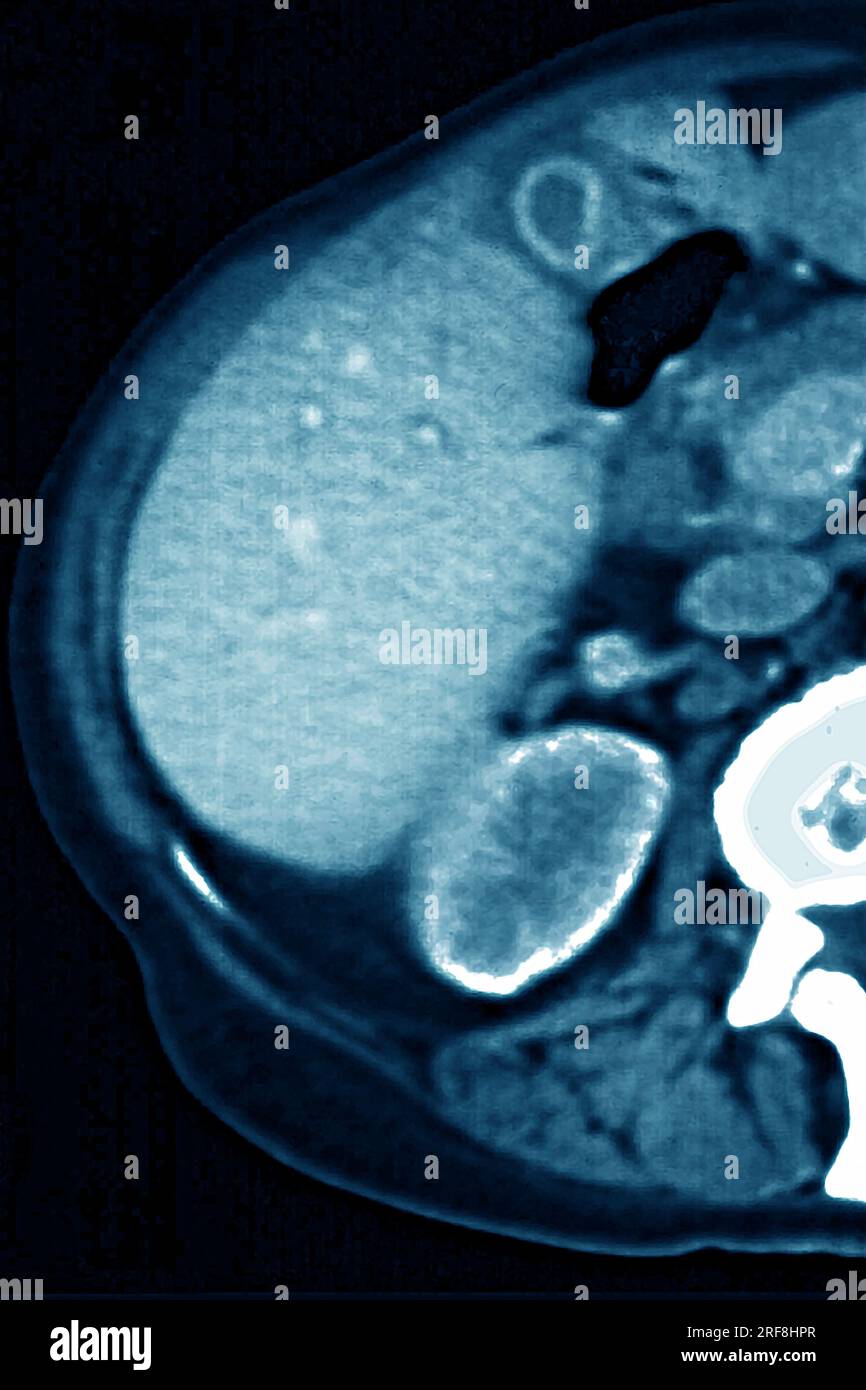 Lymphoma revealed by lymphadenopathy between the liver and the gallbladder. abdominal scan in radial section. Stock Photo