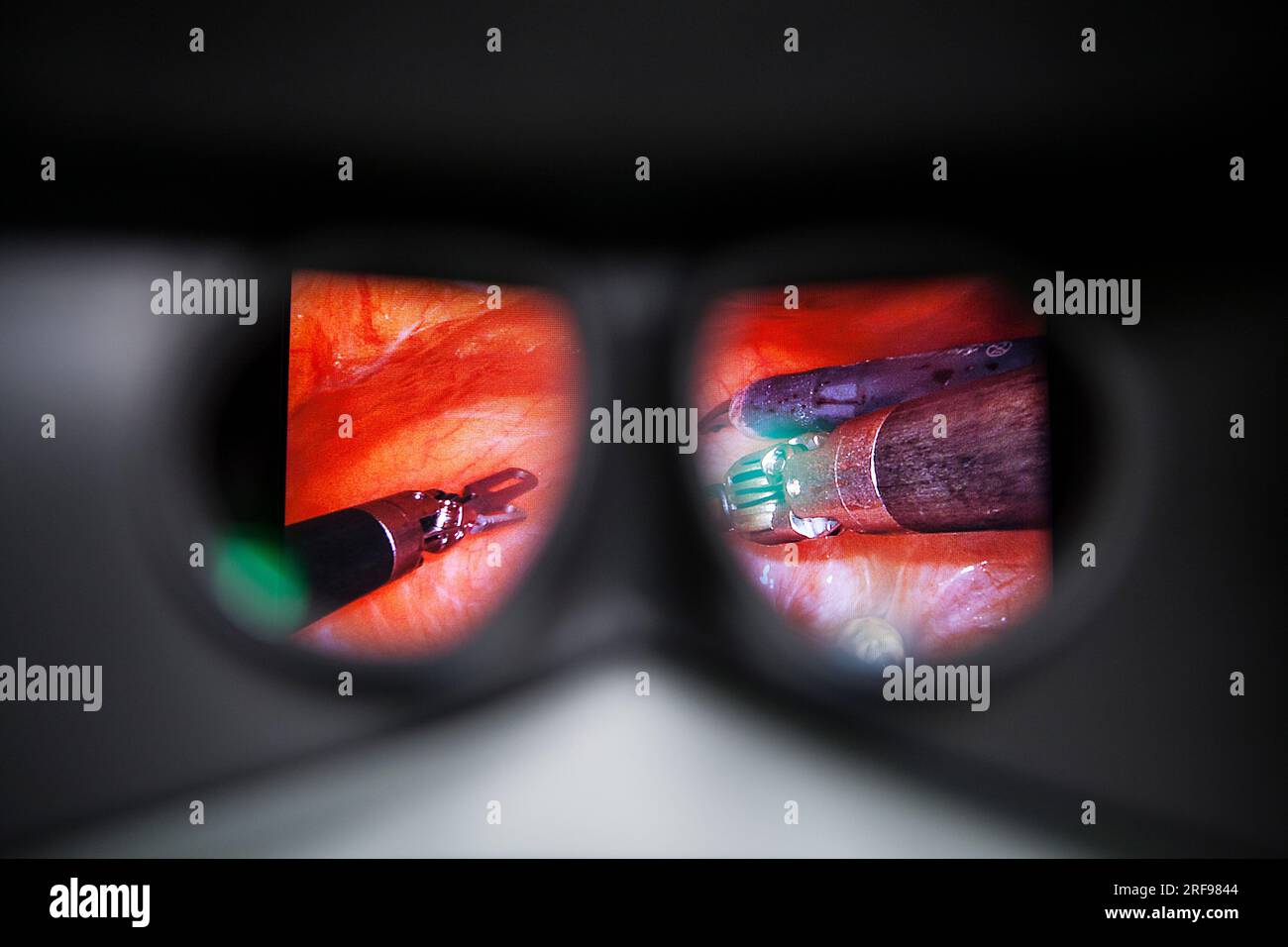 Hysterectomy in the operating room with a robot, view of the surgeon from the robot control console. Stock Photo