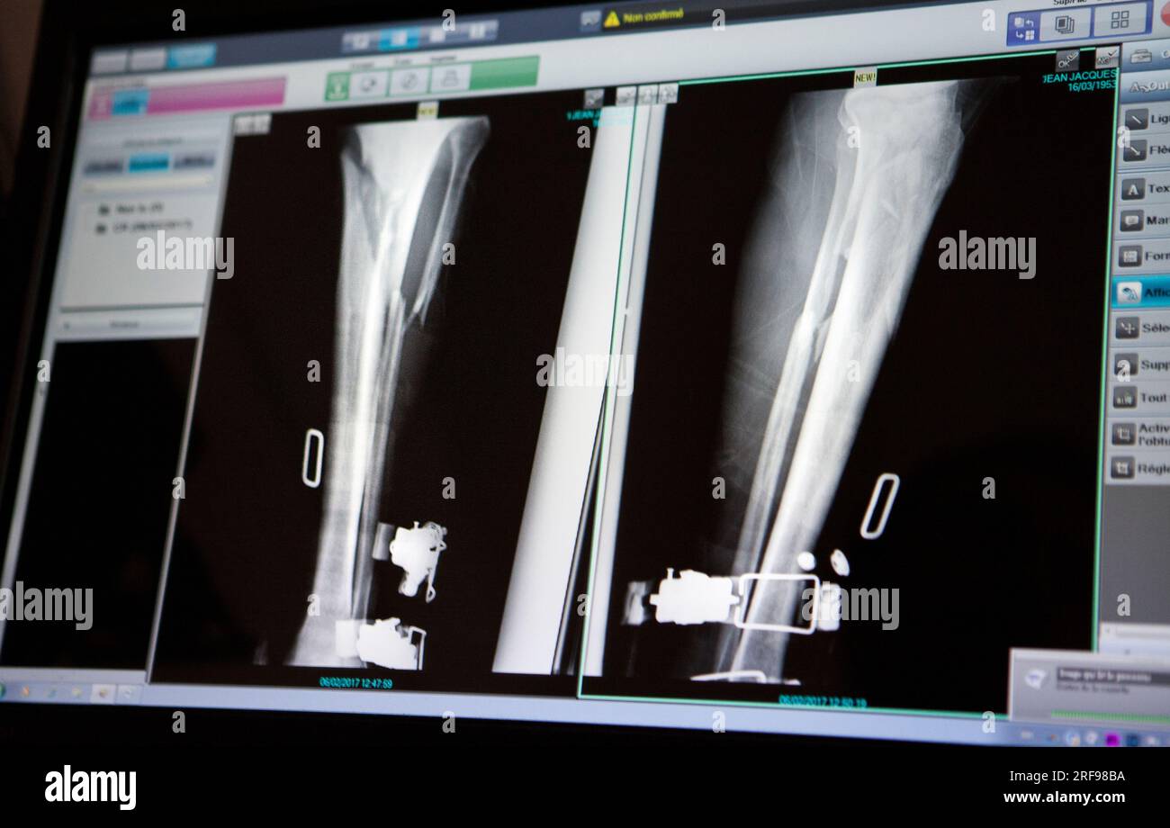 Fracture of tibia and fibula hires stock photography and images Alamy