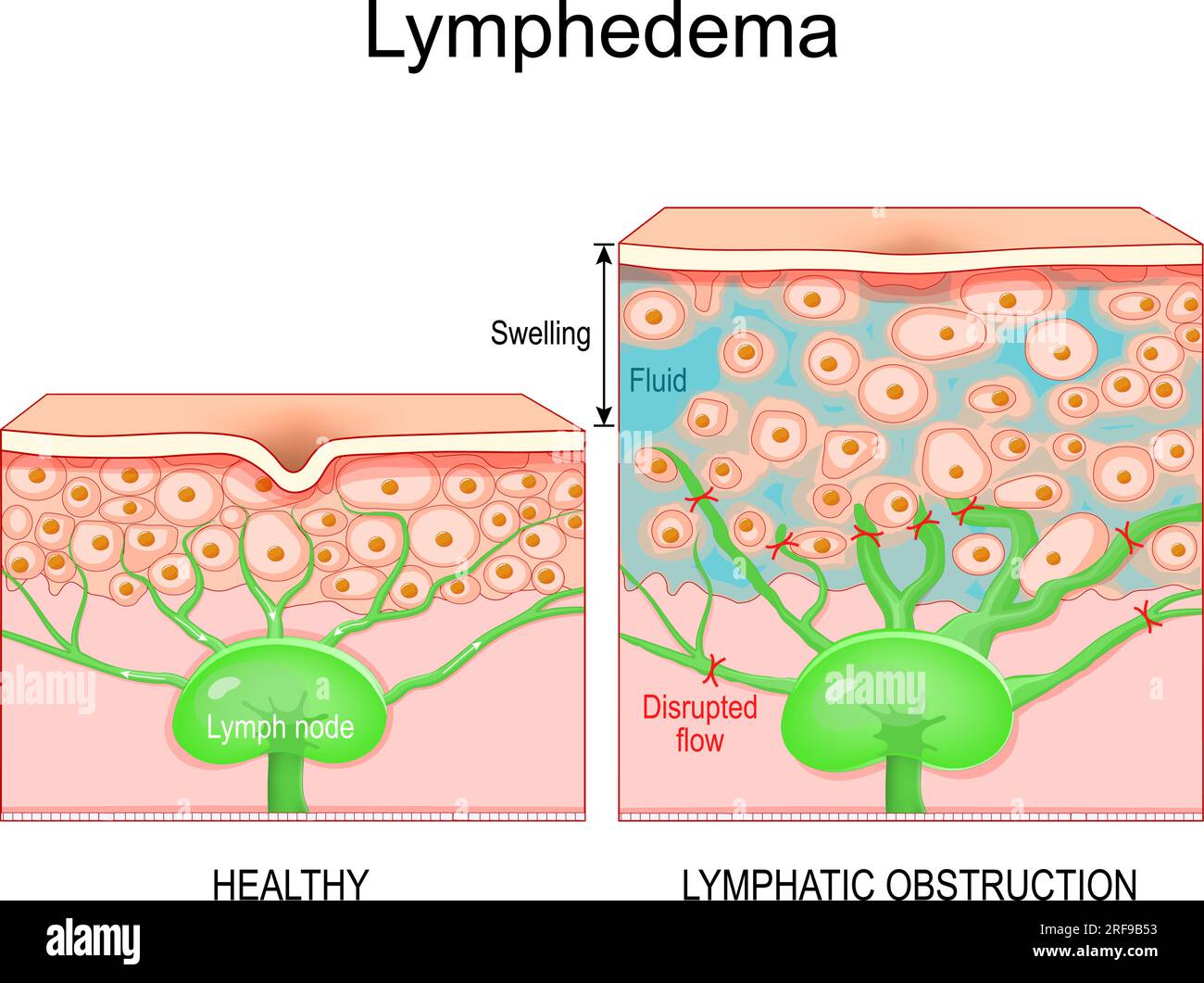 Lymphedema. Cross section of a human skin with healthy lymphatic vessel, and Swelling that caused of lymphoedema. Close-up of skin cells, and Lymph no Stock Vector