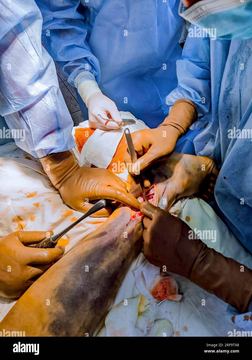 In event of leg fracture, surgeons conduct surgical procedure to install metal plate. Stock Photo