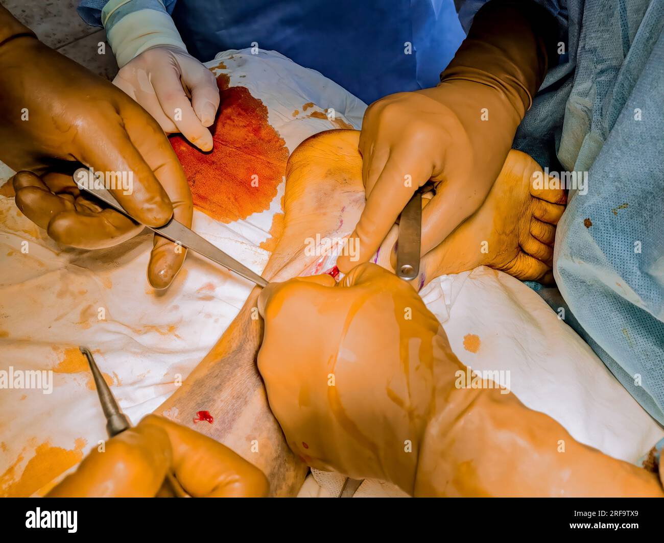 Doctors perform surgical procedure to place metal plate after leg fracture. Stock Photo