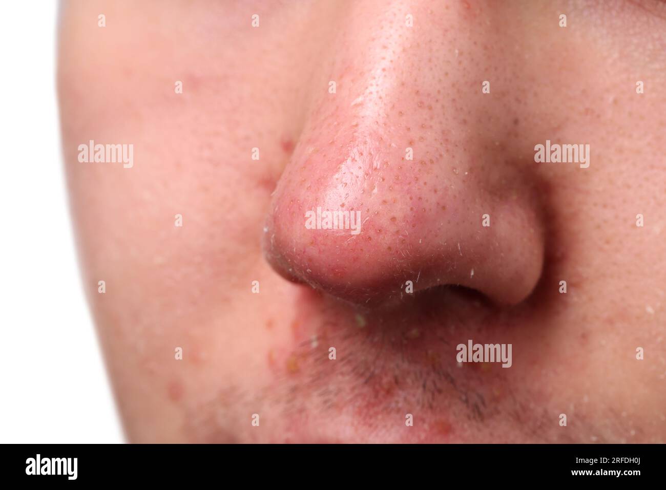 Young man with acne problem, closeup view of nose Stock Photo