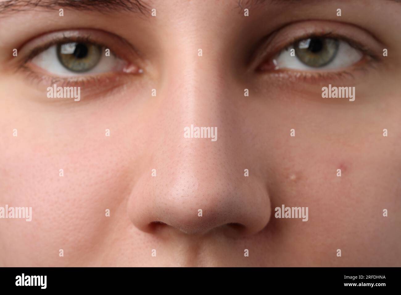 Young woman with acne problem, closeup view Stock Photo