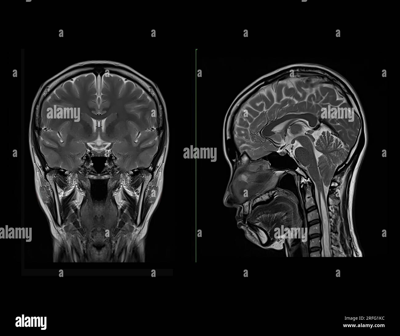 MRI  brain scan  Compare Coronal and sagittal plane for detect  Brain  diseases sush as stroke disease, Brain tumors and Infections. Stock Photo