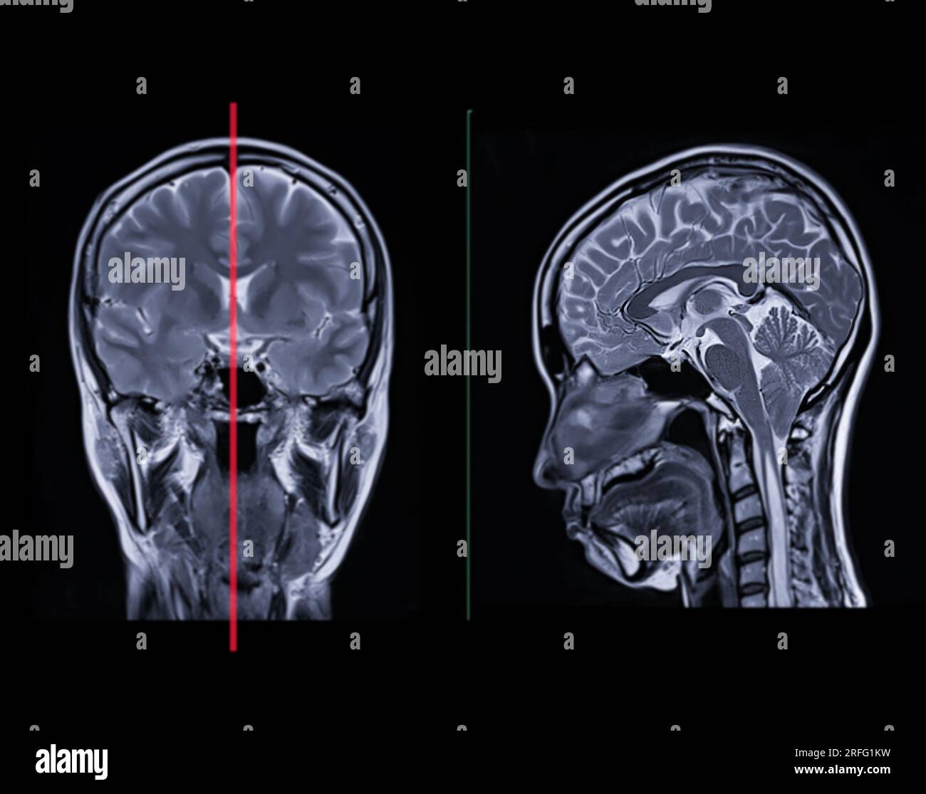 MRI  brain scan  Compare Coronal and sagittal plane for detect  Brain  diseases sush as stroke disease, Brain tumors and Infections. Stock Photo