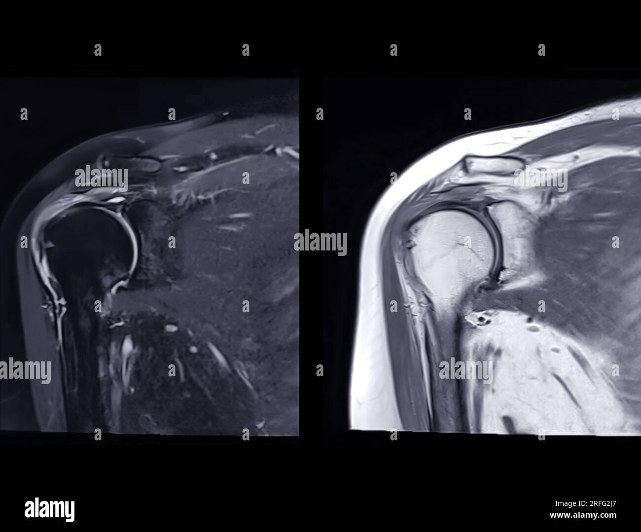 Resonance Imaging or MRI of Shoulder Joint Coronal T2 FS and PDW for diagnostic